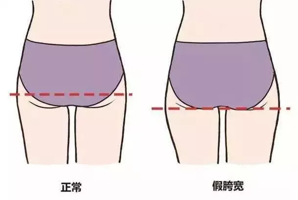 你也許不是真腿粗，而是假胯寬！