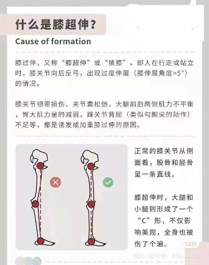 少兒形體問(wèn)題—膝超伸的危害